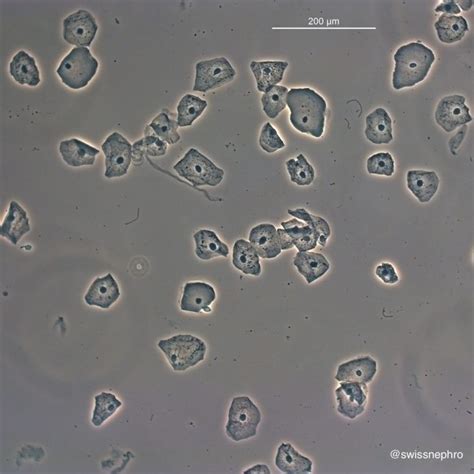 It is not uncommon to find transitional epithelial cells in the normal urine sediment; however, if they are present in large numbers or clumps and have an abnormal histology. . High number of squamous cells in urine